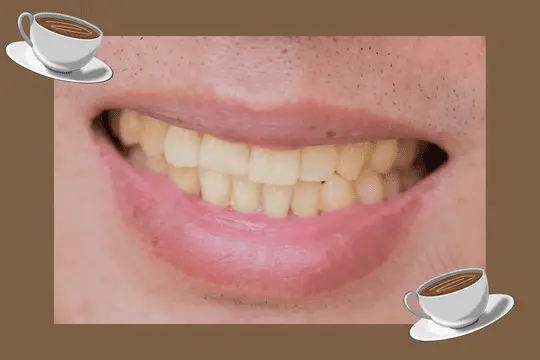 coffee stained teeth picture