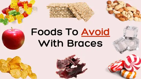foods to avoid with braces images of nuts, gummy bears. crackers, ice, hard candy, beef jerky, apple and chips