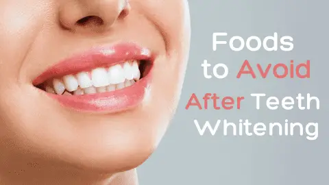 foods to avoid after teeth whitening featured image