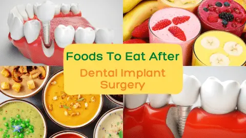 foods to eat after dental implant surgery